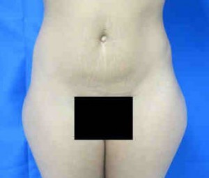 Brazilian Butt Lift