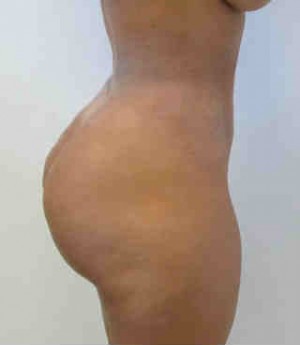 Brazilian Butt Lift
