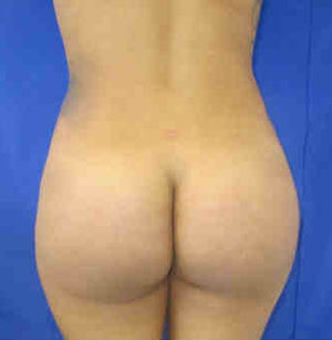Brazilian Butt Lift