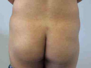 Brazilian Butt Lift