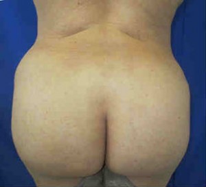 Brazilian Butt Lift