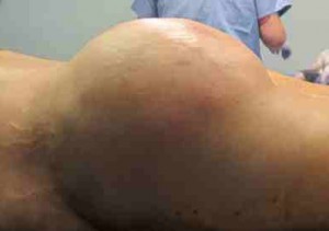 Brazilian Butt Lift