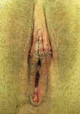 Labial Rejuvenation