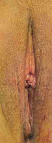 Vaginal Rejuvenation