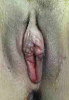 Vaginal Rejuvenation