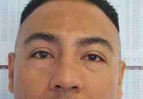 Male Eyelid Surgery