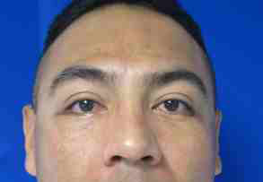 Male Eyelid Surgery