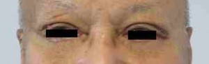 Male Eyelid Surgery