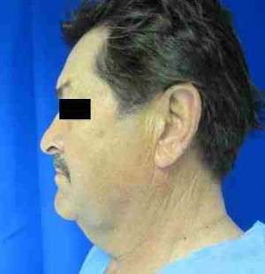 Male Neck Lift