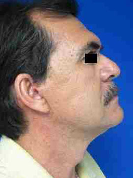 Male Neck Lift