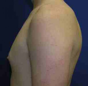 Gynecomastia