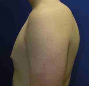 Gynecomastia