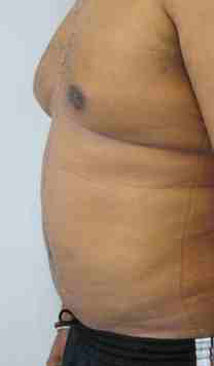 Gynecomastia