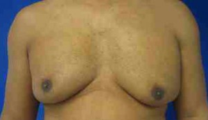 Gynecomastia