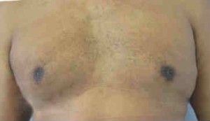 Gynecomastia