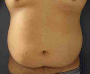 Male Liposuction