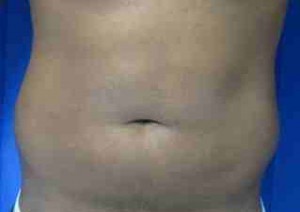 Male Liposuction