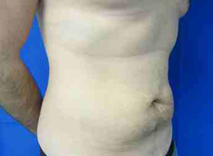 Male Liposuction