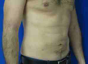 Male Liposuction