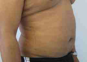 Male Liposuction