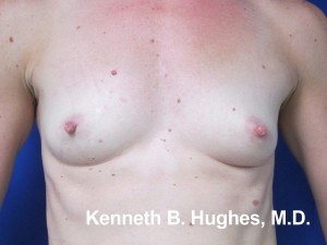 Breast Augmentation (Implants)