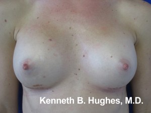 Breast Augmentation (Implants)