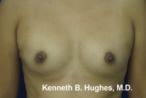 Breast Augmentation (Implants)