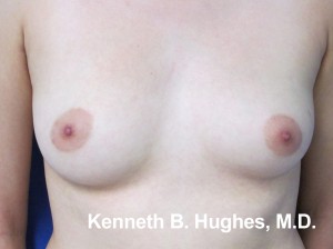 Breast Augmentation (Implants)