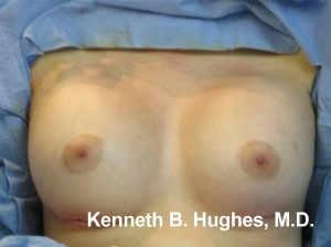 Breast Augmentation (Implants)