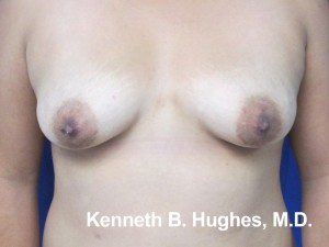 Breast Augmentation (Implants)