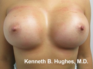 Breast Augmentation (Implants)