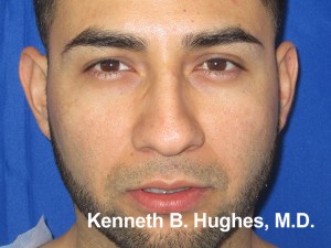 Rhinoplasty