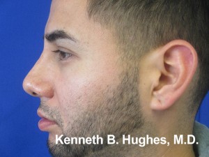 Rhinoplasty