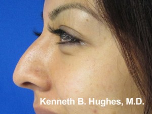 Rhinoplasty