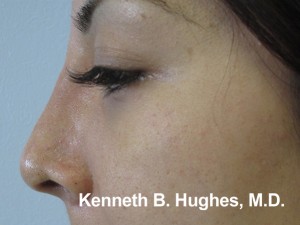 Rhinoplasty