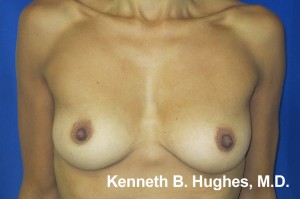 Breast Augmentation (Implants)