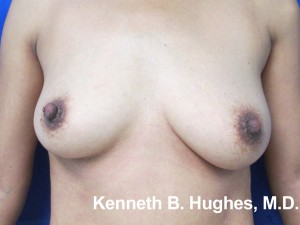 Breast Augmentation (Implants)