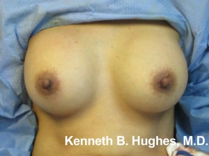 Breast Augmentation (Implants)