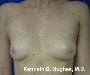 Breast Augmentation (Implants)