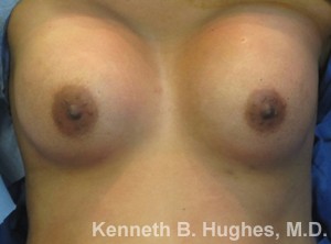 Breast Augmentation and Lift