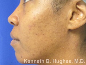 Facial Fat Grafting and Stem Cell Rejuvenation