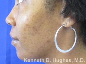 Facial Fat Grafting and Stem Cell Rejuvenation