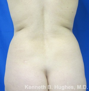 Liposuction