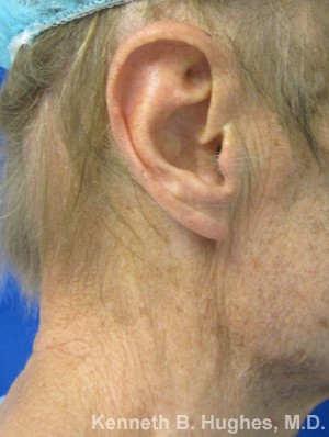 Ear Correction