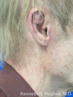 Ear Correction