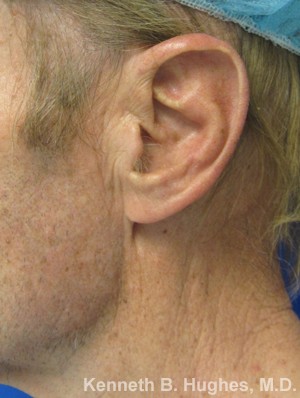 Ear Correction