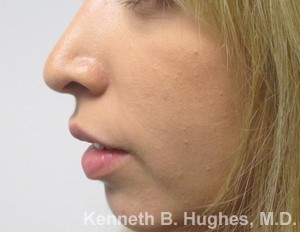 Rhinoplasty