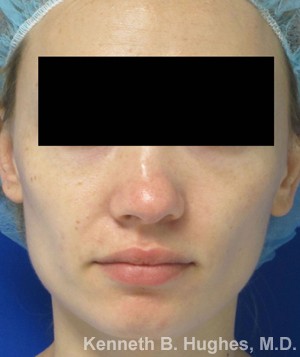 Rhinoplasty