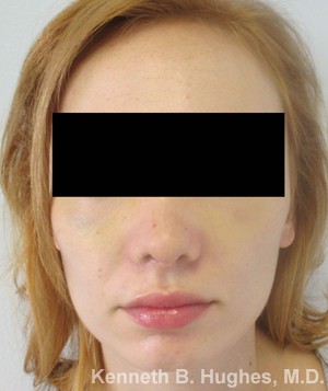 Rhinoplasty