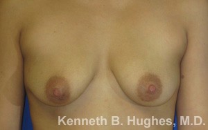 Breast Augmentation (Implants)